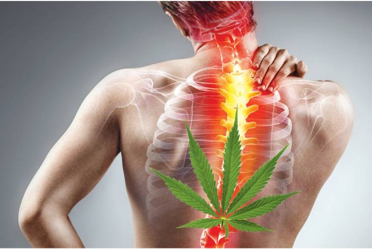 How Medical Marijuana Works in Relieving Sciatica Pain